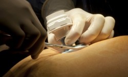 Hernia Incisional