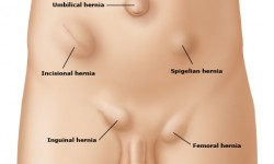 Hernias de la pared Abdominal