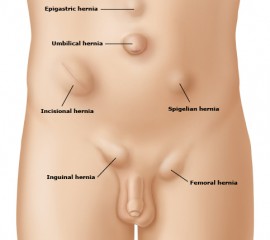 Hernias de la pared Abdominal