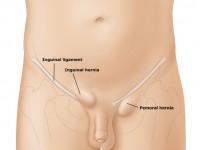 Hernia inguinal y femoral