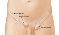 Hernia inguinal y femoral