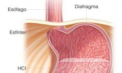 Acidez y reflujo gastroesofágico